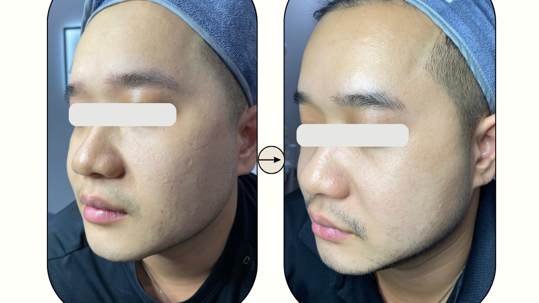 ANH MAI skinlab - Trị Mụn và Sẹo Rỗ chuẩn y khoa